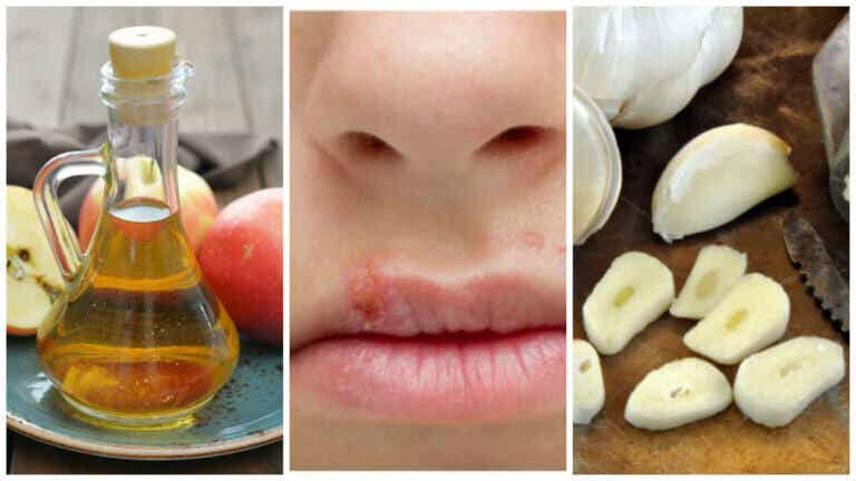 Combate el herpes labial de forma eficaz con estos 7 remedios caseros