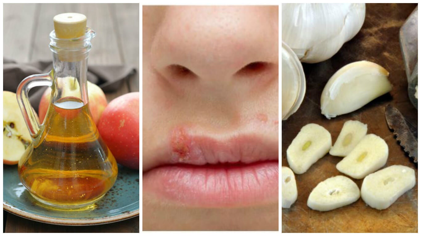 Seguro compartir Vaciar la basura Combate el herpes labial de forma eficaz con estos 7 remedios caseros -  Mejor con Salud