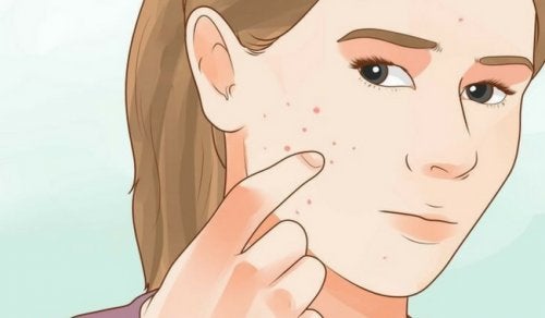 Como diferenciar los distintos tipos de acne en la cara