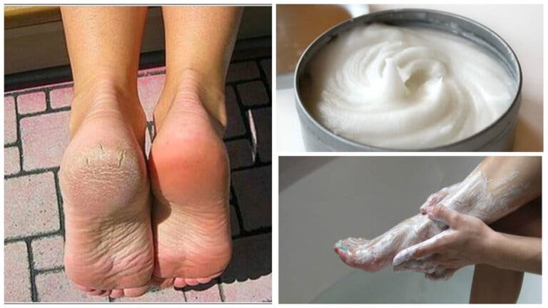 Remedio casero para los callos y los hongos en los pies