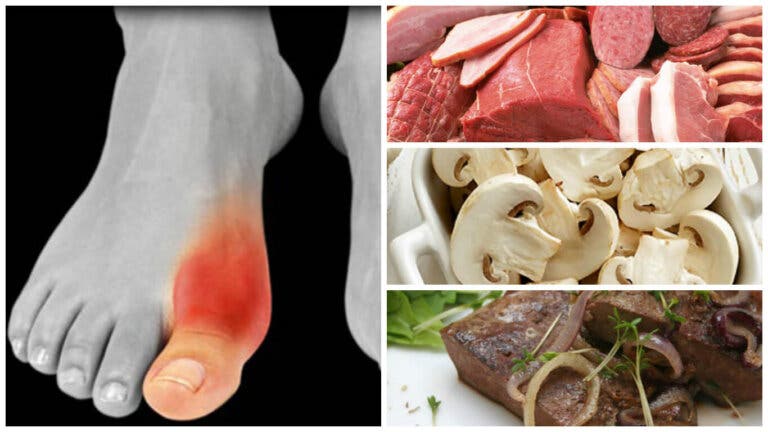 ¿Padeces de gota? Estos son los 8 alimentos que debes evitar en tu dieta
