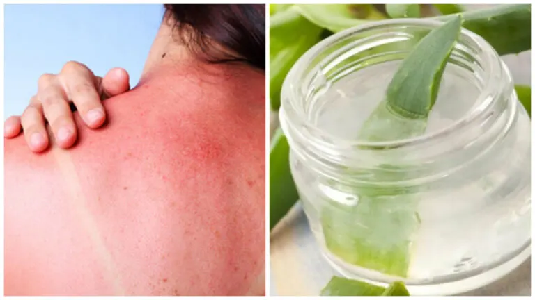 Gel de aloe vera para calmar las quemaduras solares