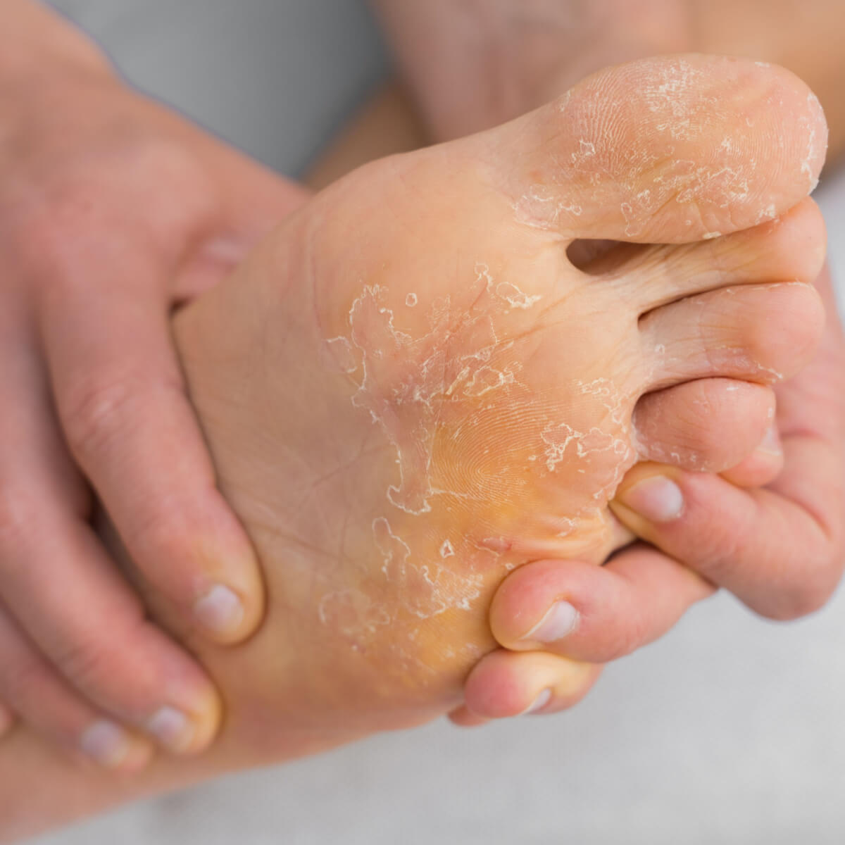 Ba o Casero Para Tratar Los Hongos En Los Pies TBFDRI Ba o Casero Para Tratar Los Hongos En Los Pies TBFDRI