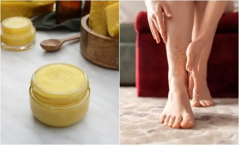 Pomada de árnica: ¿útil para atenuar las varices y las arañitas?