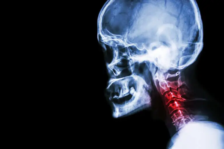 Espondilosis cervical: síntomas y tratamientos naturales