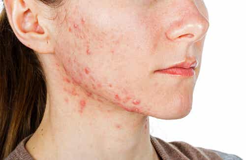 Tratamientos internos para el acné