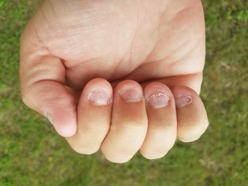 Uñas mordidas