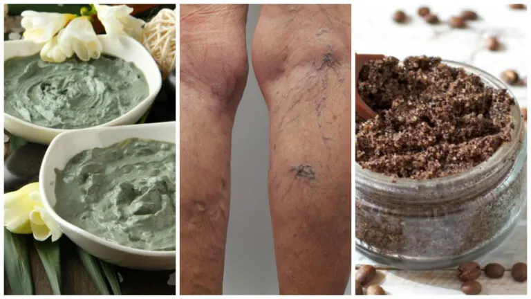 ¿Se puede quitar de forma natural las varices?