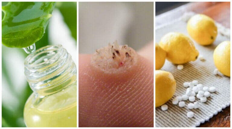 Elimina las verrugas de tu cuerpo con estos 6 eficaces remedios