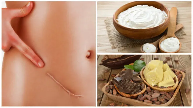 Los 7 mejores remedios para atenuar las cicatrices de forma natural