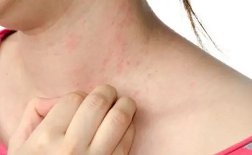 Mujer con urticaria en el cuello.