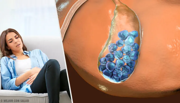 Cálculos en la vesícula: cómo evitarlos