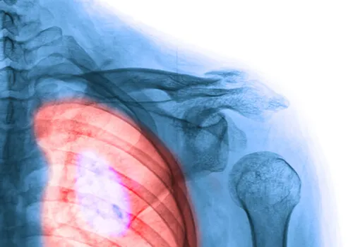 Cáncer de pulmón