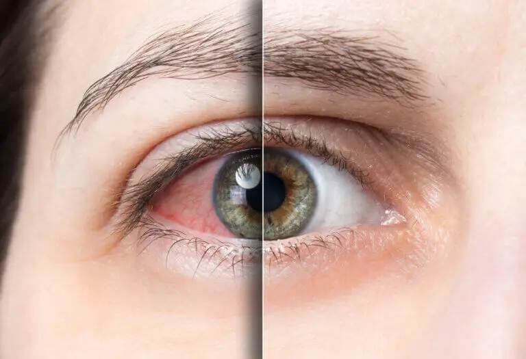 Desprendimiento de retina qué es, causas y cómo evitarlo