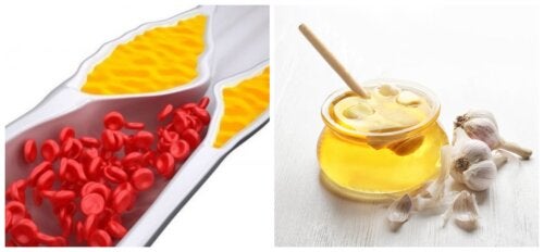 Cómo preparar un jarabe para reducir el colesterol y desinflamar las articulaciones