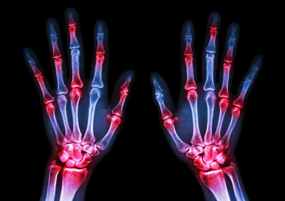 Radiografía de las manos en enfermedades endocrinas.