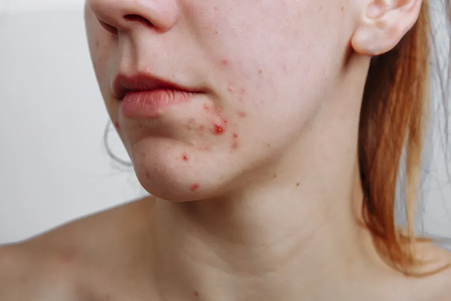 Il a une activité antiséborrhéique