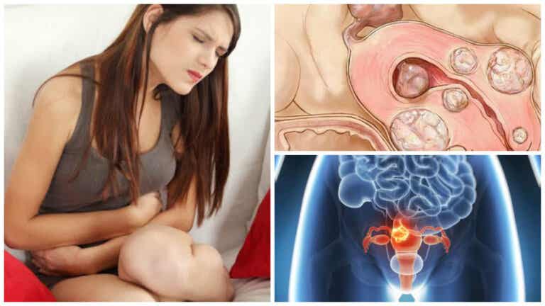 5 datos de los miomas uterinos que toda mujer debe saber