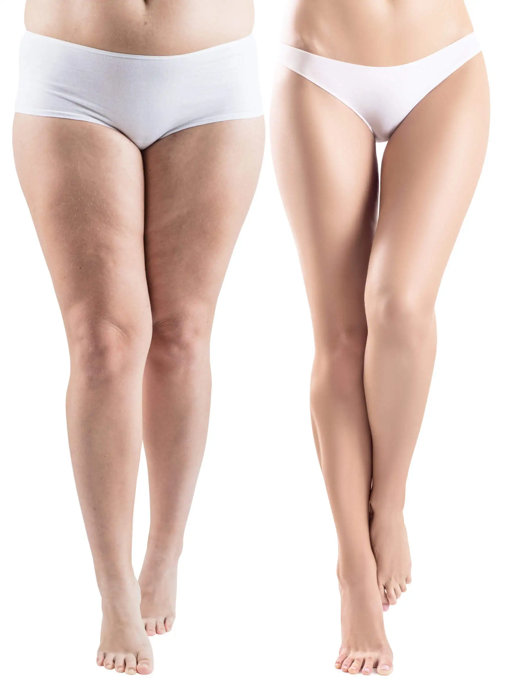 Combate la celulitis con algunas infusiones.