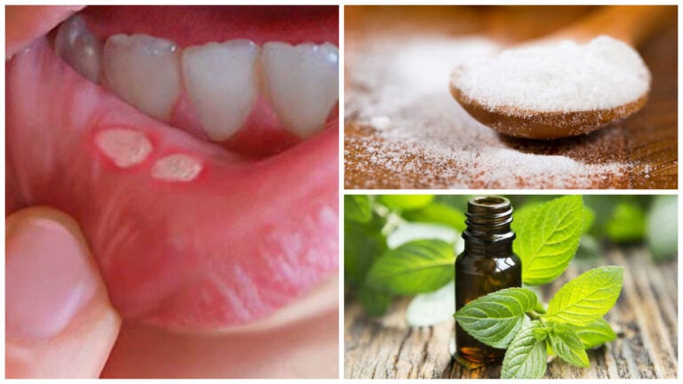 7 tratamientos caseros para las llagas de la boca