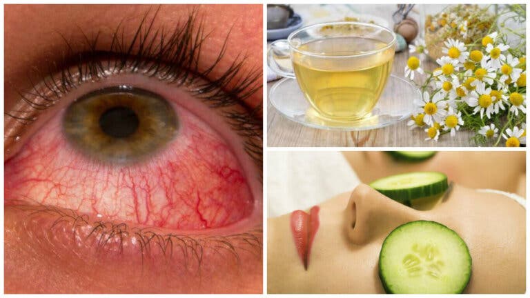 Alivia la conjuntivitis con estos 6 remedios naturales