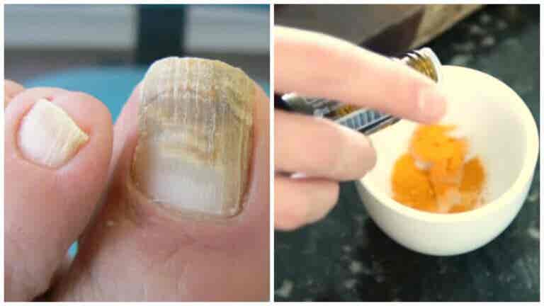 La cúrcuma tratamiento natural para los hongos en la uñas