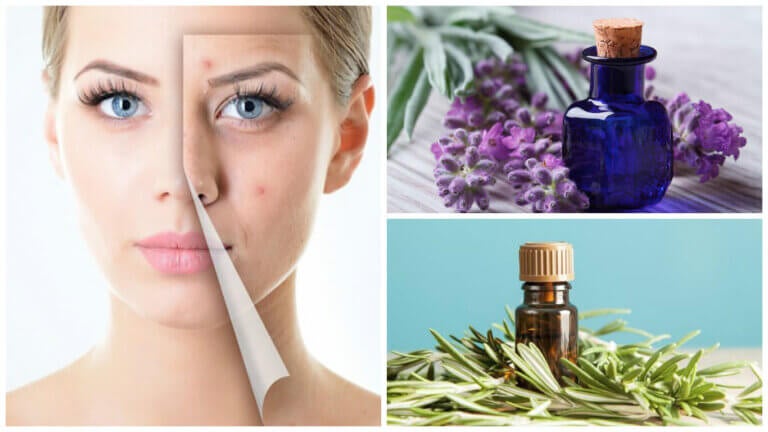 Piel con acné: 6 aceites esenciales para combatirlo - Labiatae