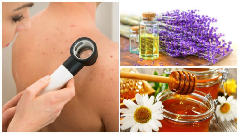 Los 6 mejores tratamientos caseros para combatir el acné de la espalda