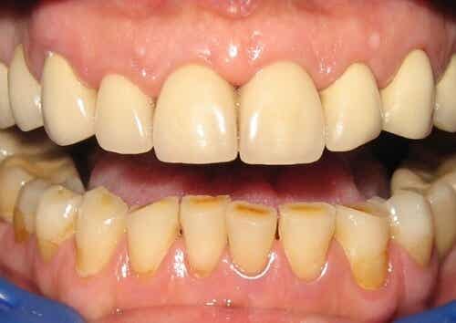 10 formas de eliminar la placa dental naturalmente