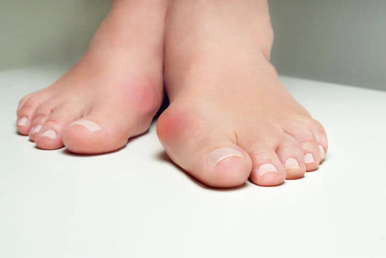 7 formas de aliviar el dolor por juanetes