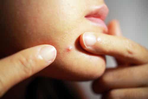 Loción hidratante para la piel con acné