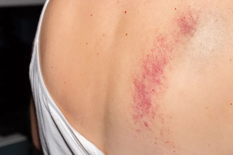 9 soluciones naturales para tratar los moretones