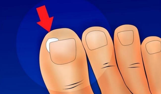 Cómo evitar que se nos encarnen las uñas