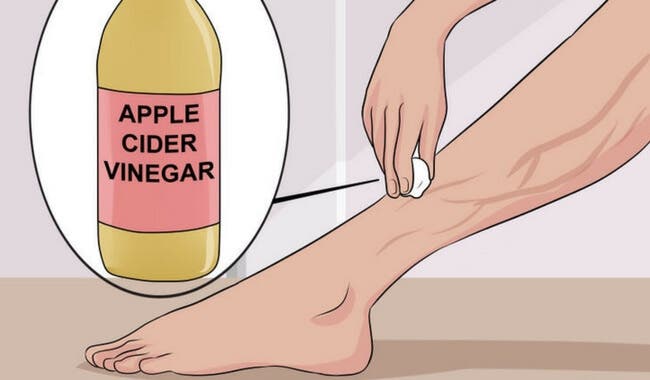 Trata las varices con aloe vera, zanahoria y vinagre de manzana