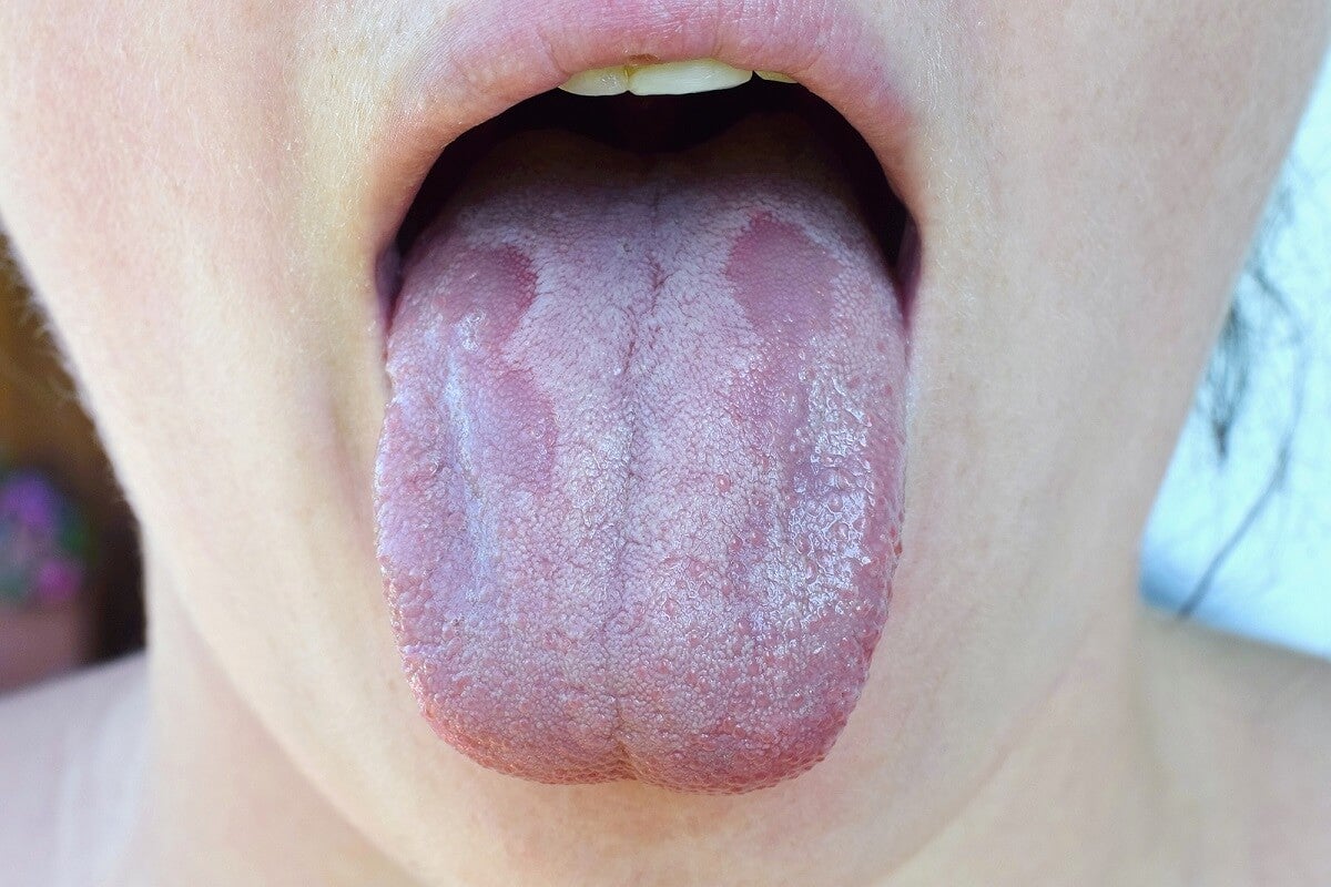 Lo que dice de tu salud el color de tu lengua