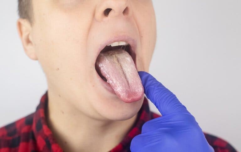 Dieta para la candidiasis: alimentos permitidos y prohibidos