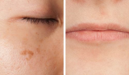 5 síntomas de la falta de vitaminas que pueden leerse en el rostro