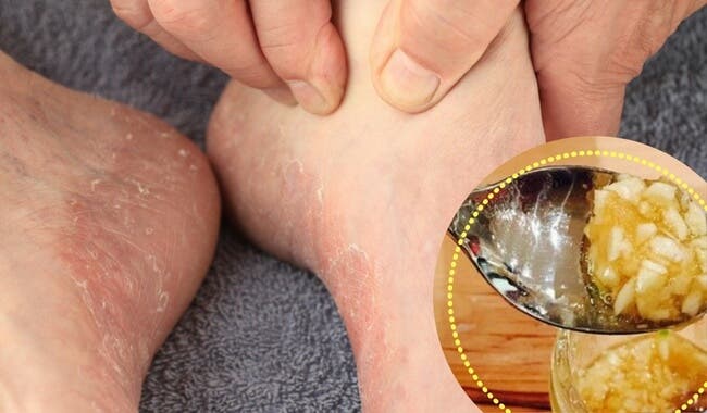 6 productos naturales que ayudan para el pie de atleta