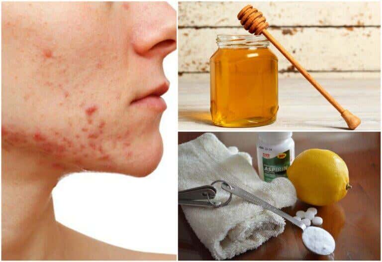 6 remedios naturales para hacerle frente al acné quístico