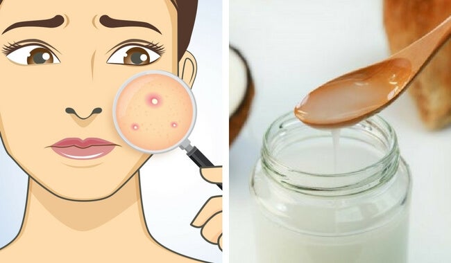 Crema hidratante casera combatir el acné manera