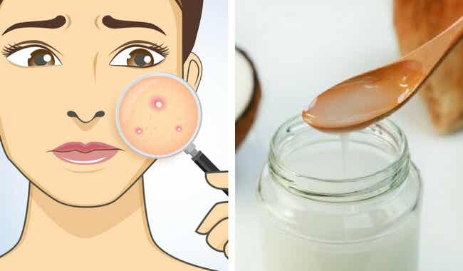 Crema hidratante casera para combatir el acné de manera natural