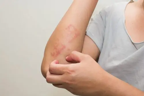 Hombre con psoriasis rascándose el brazo