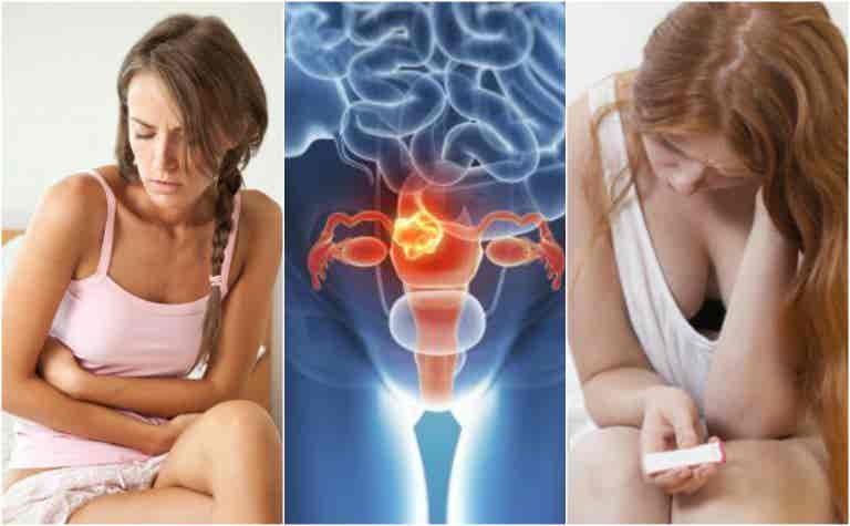 ¿Qué son los miomas uterinos? 5 datos importantes