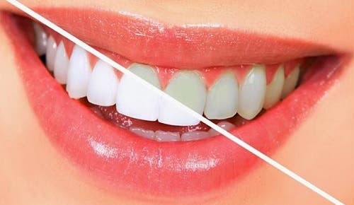 10 alimentos para blanquear los dientes naturalmente