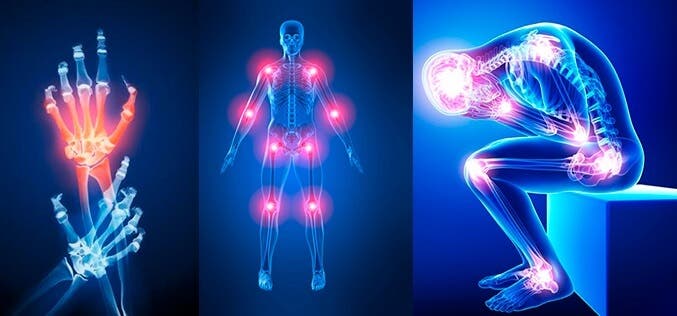 7 razones por las que te duelen las articulaciones