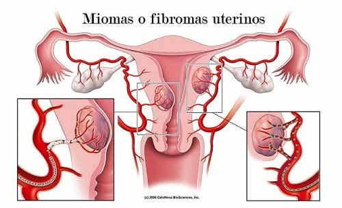 Fibromas