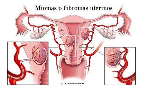 Fibromas