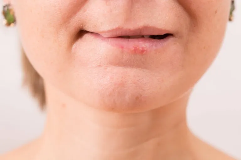 Cura tus labios quemados con estos 7 remedios naturales