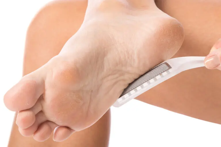 Cómo quitar los callos de forma natural