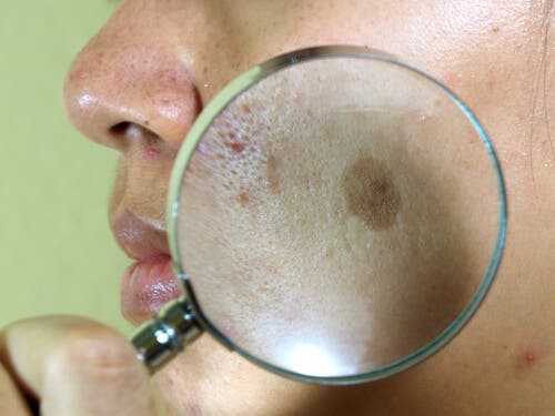 7 tratamientos naturales para el paño en la cara